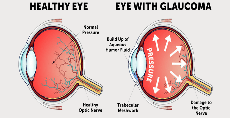 Glaucoma Eye Diagram