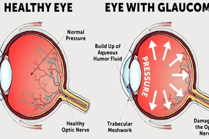 Glaucoma Eye Diagram