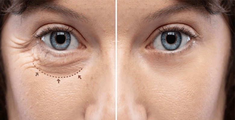 Oculoplastic Surgery