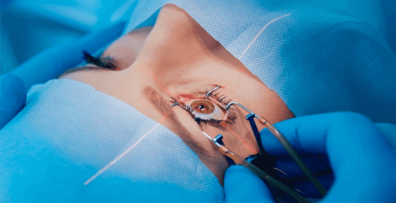 Cataract