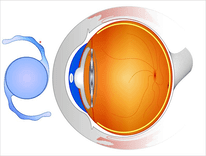cataract